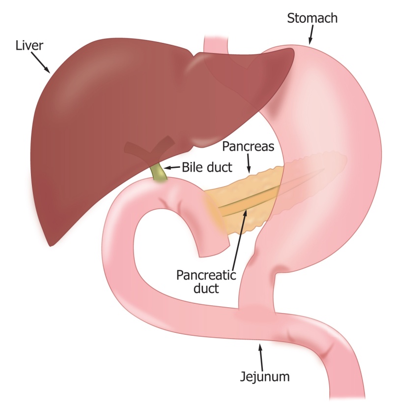 胆肠吻合术后吻合口狭窄梗阻咋办,胆肠吻合术后胆瘘怎么处理