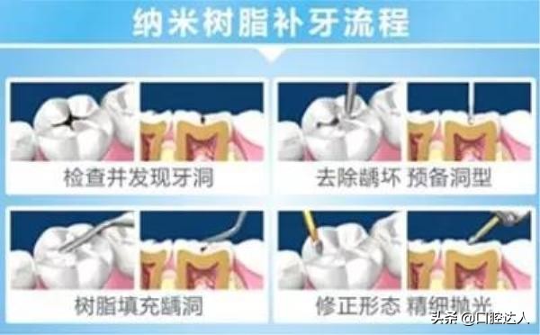 补牙能治好牙痛吗,补牙后为什么会越来越痛