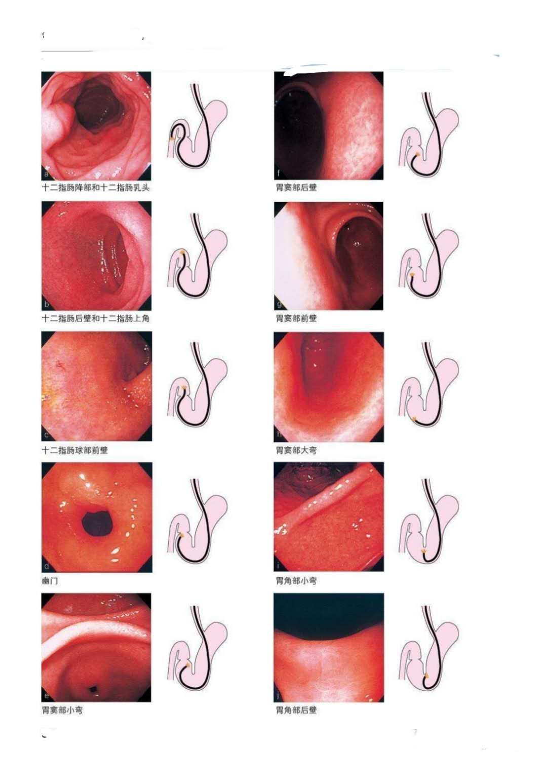 胃部钡餐和胃镜哪个好,胃部钡餐和胃镜的区别