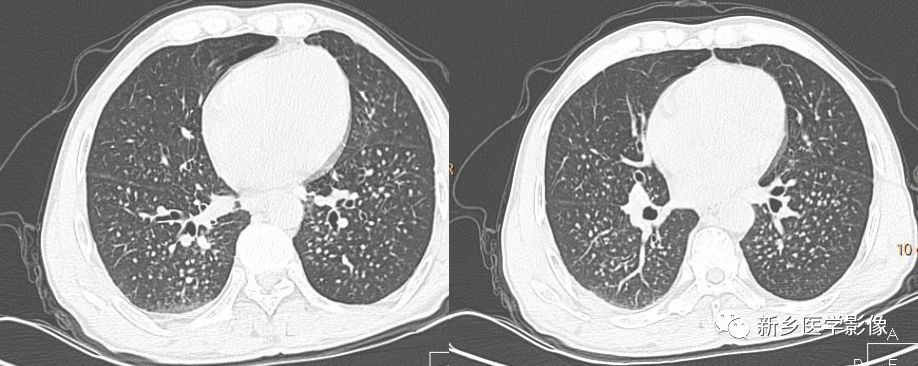 矽肺影像诊断报告,矽肺拍片什么症状