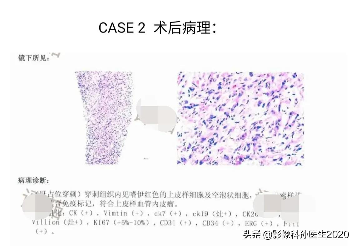肝上皮样血管内皮瘤全国多少例,肝上皮样血管内皮瘤超声表现