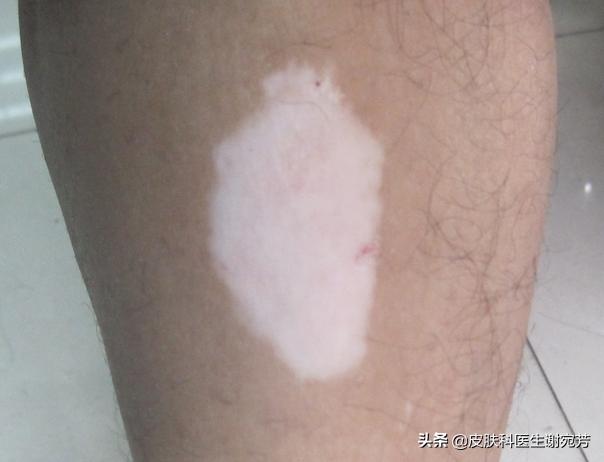 花斑癣白斑和白癜风白斑的区别,长了白斑能自愈是白癜风吗