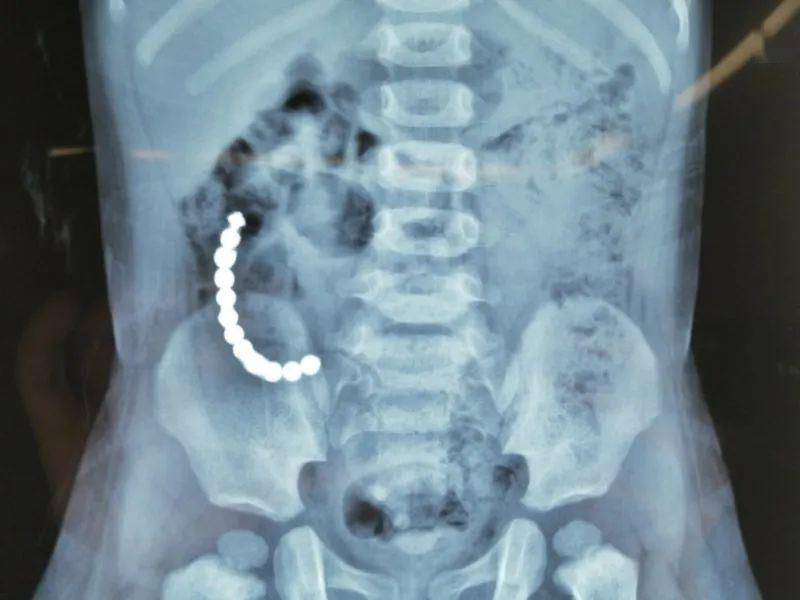 小孩误食塑料珠子几天能排出来,宝宝误食了一颗塑料珠子