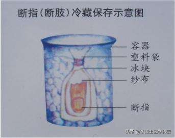 手外伤撕裂恢复最佳方法,手外伤的急救处理与断指的保存