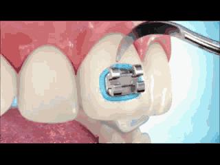 矫正科普15秒,科普矫正