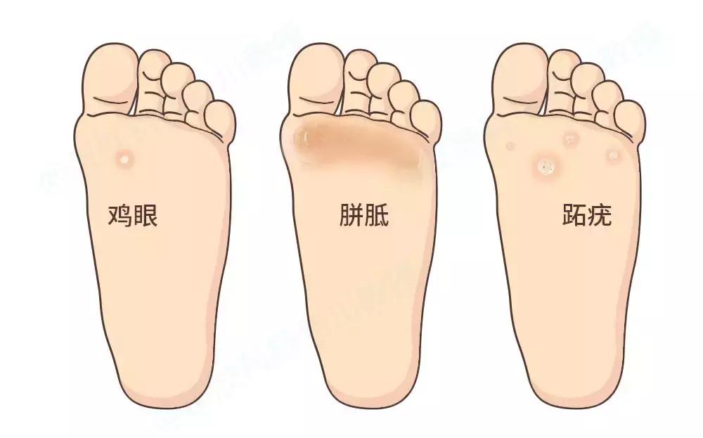 鸡眼与跖疣如何区分呢,鸡眼和跖疣的区别及治疗