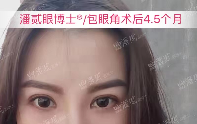 开内眼角会留疤的照片,开内眼角的疤痕变白色了怎么办