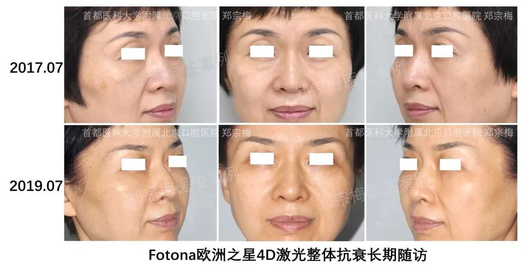 fotona4d有效果吗,fotona4d做完前后对比
