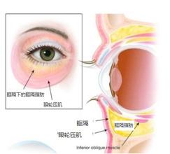 如何分清自己是哪种类型的眼袋,怎么看是哪种类型的眼袋