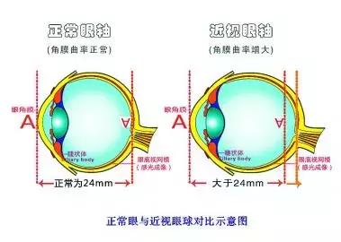 父母近视孩子就一定近视吗,父母近视孩子会怎么样