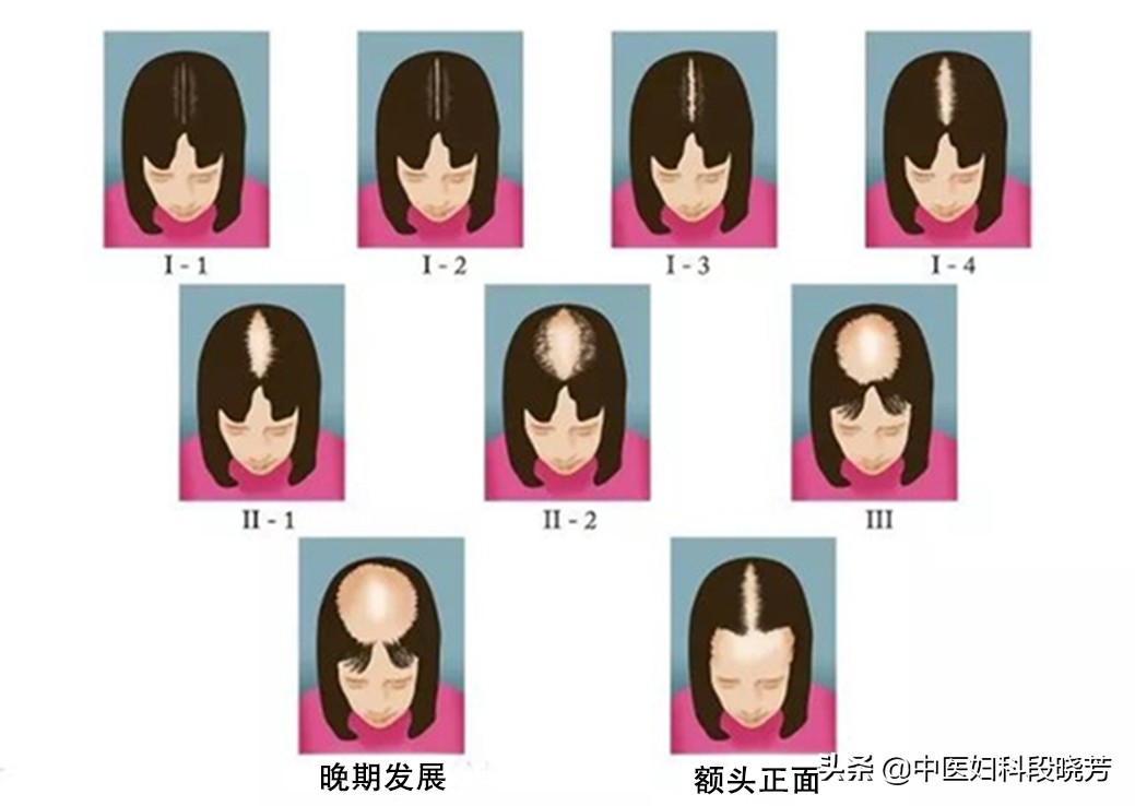 月经不正常长痘脱发是卵巢多囊吗,多囊卵巢综合症脱发头皮长痘