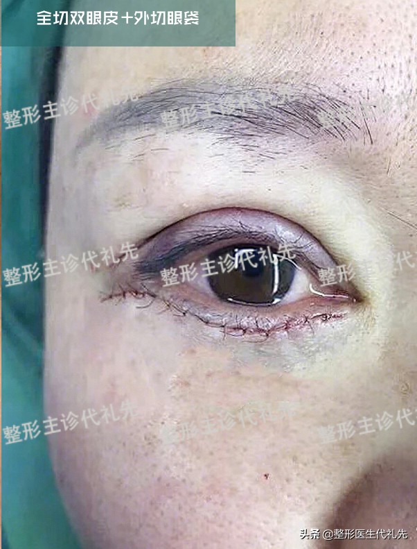 新月形双眼皮好看还是扇形好,新月型与平扇形双眼皮的区别