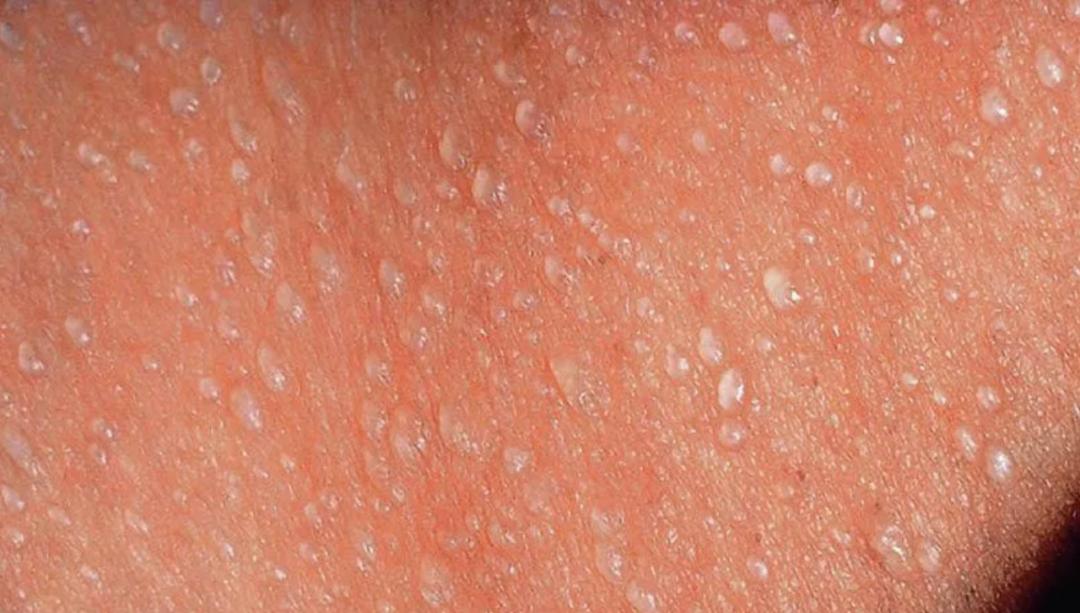 汗疱疹湿疹痱子的皮肤护理,汗疱疹和痱子怎么治