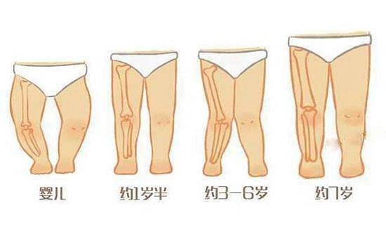 成年人o型腿最快变直的方法,成人o型腿怎么变直锻炼方法