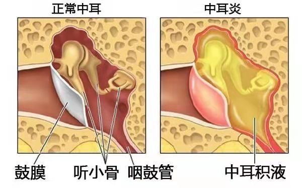 治中耳炎用眼药水,中耳炎常用药