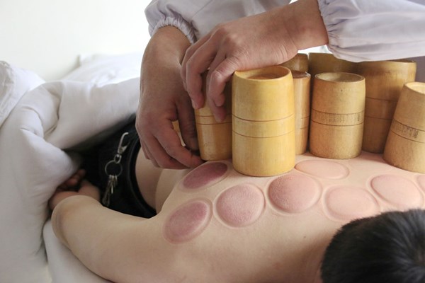 拔罐后皮肤上紫黑色印记，是什么？