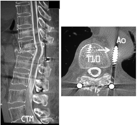 胸椎韧带损伤最佳治疗方法,胸椎损伤与复位