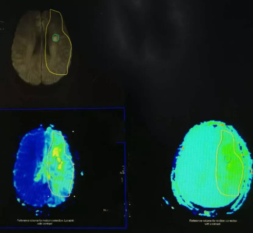颅内动脉支架成形术，让塌陷的颅内动脉重获新生
