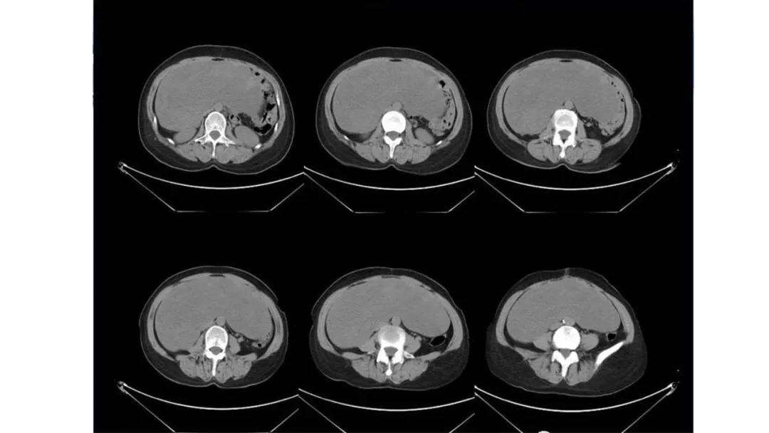 卵巢原发肿瘤的分析思路