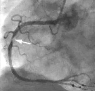 有耳褶的都是冠心病吗,有耳纹的人应该注意什么