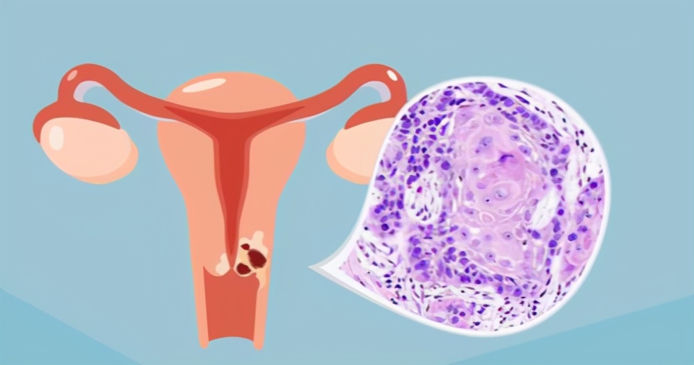 宫颈癌复发等死吗,宫颈癌复发适合做介入吗