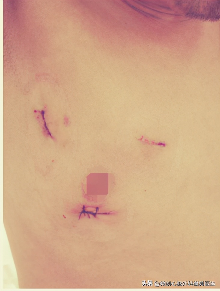 浙江省人民医院做心脏手术如何,浙江人民医院微创心脏手术