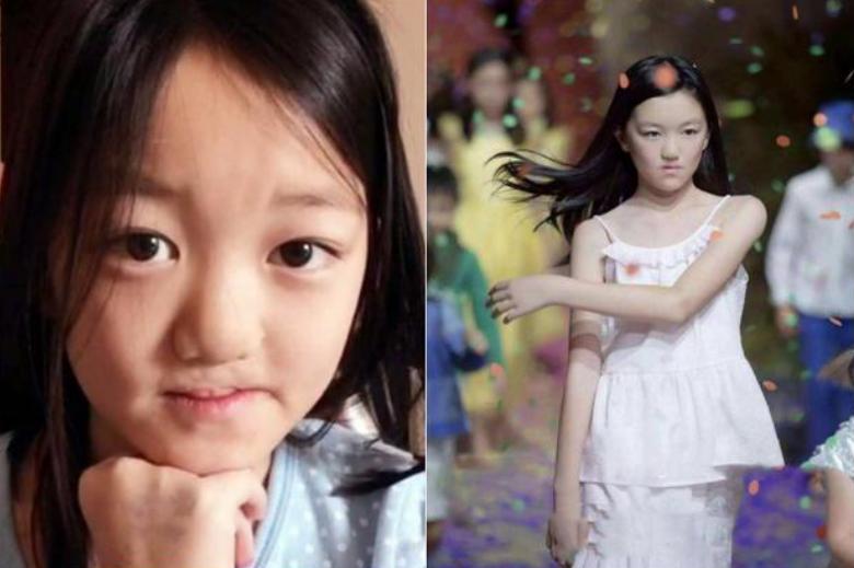 李嫣兔唇是不是很严重,李嫣兔唇现在怎么样了