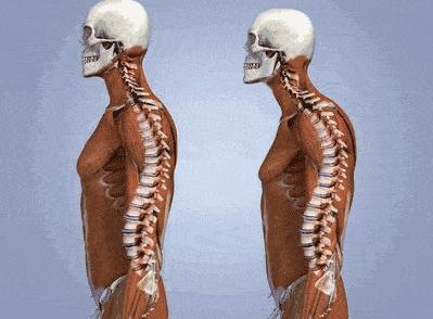 你以为你是翘臀其实是骨盆前倾,你以为的翘臀有可能是骨盆前倾