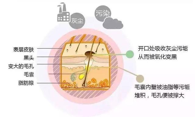 去黑头的最好方法医生建议,皮肤科医生手把手教你解决黑头