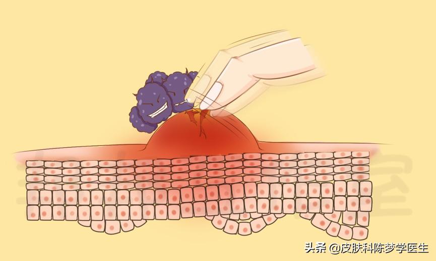 被蚊虫叮咬留下的“红包”怎么办？你可以选择这些药膏