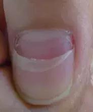 指甲脱落没掉完该怎么办,手足口痊愈后指甲脱落正常吗