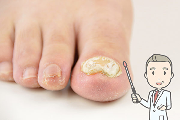 得了灰指甲治疗后指甲会不会变白,半边指甲变黄变厚可能是灰指甲吗