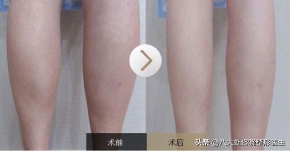 瘦脸针瘦腿针瘦肩针该怎么选,瘦肩针跟瘦脸针是不是一样的