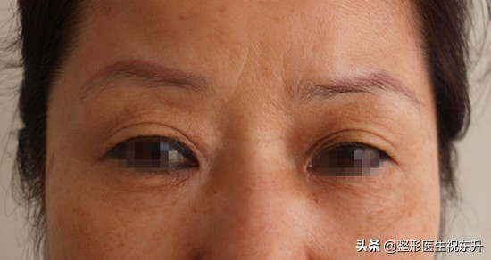 妈妈想做眉毛,妈妈急需做手术