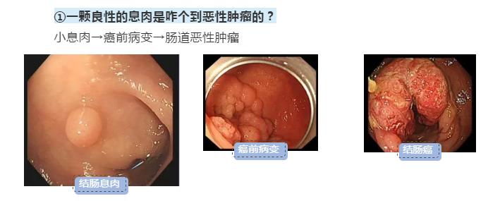 拉血是痔疮还是直肠癌,大便时滴鲜红血是肠癌还是痔疮