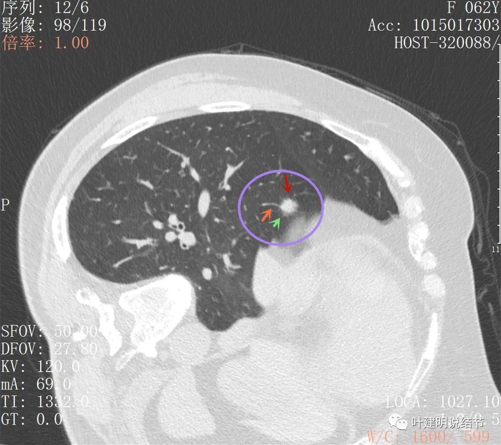 左肺癌手术半年右肺下角还有炎症,左下肺癌晚期