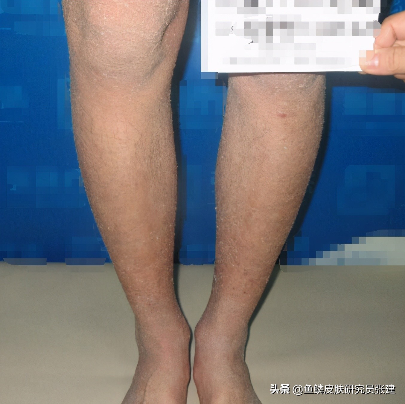 老公有鱼鳞病会遗传吗,老公有鱼鳞病15个月了还会有吗