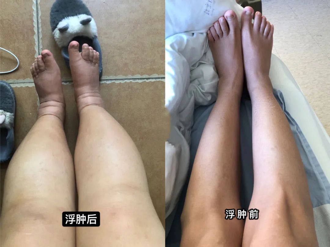 一年血肌酐从120提升到140,两年肌酐从80涨到160