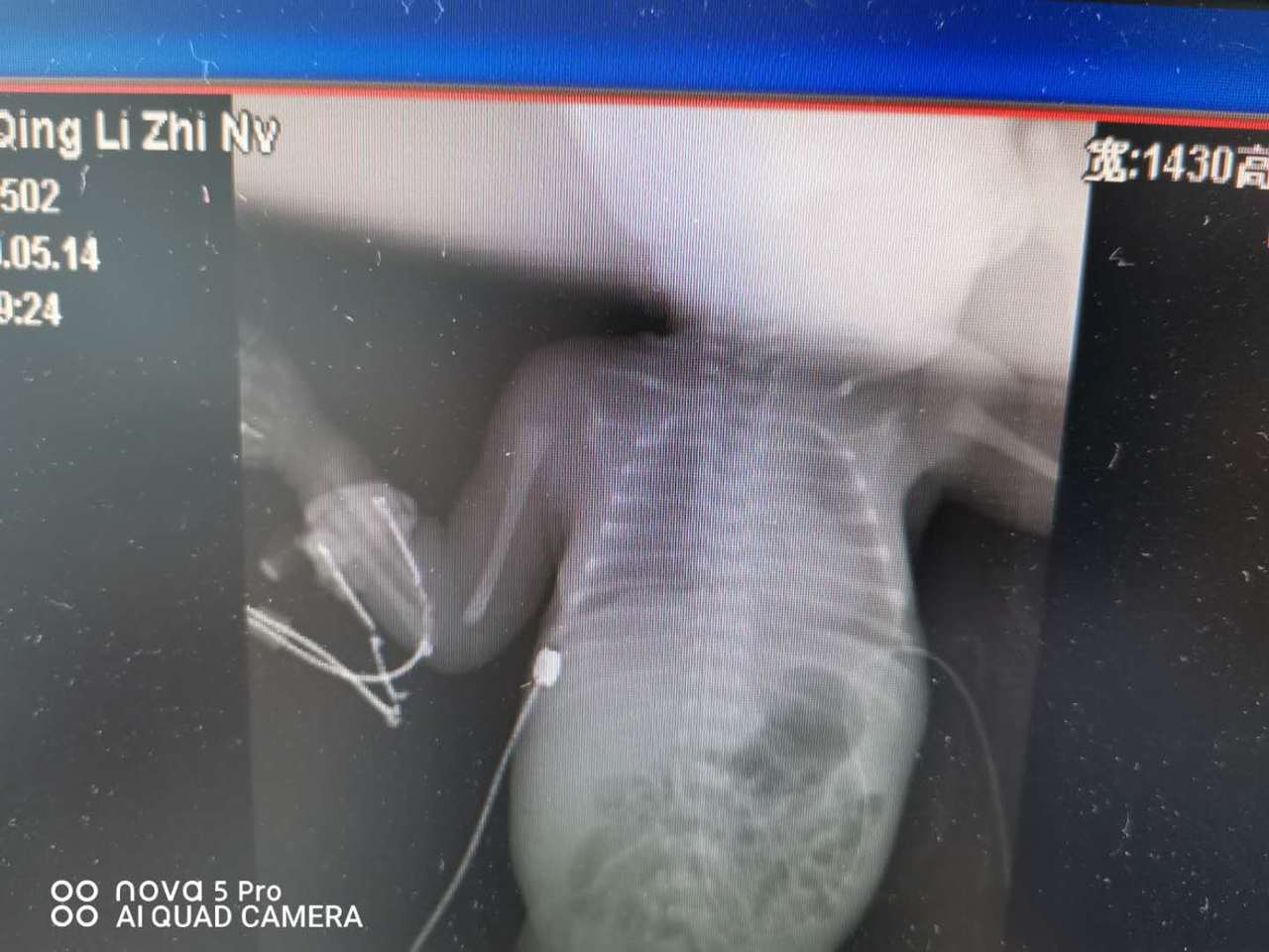 喜报我院,早产儿抢救室用呼吸机