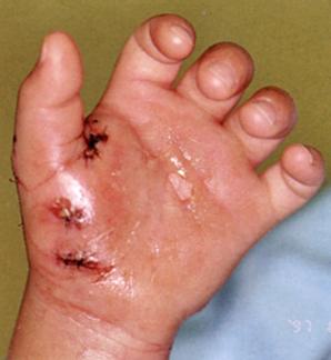 儿童简单外伤的处理方法,如何讲解儿童外伤处理小常识