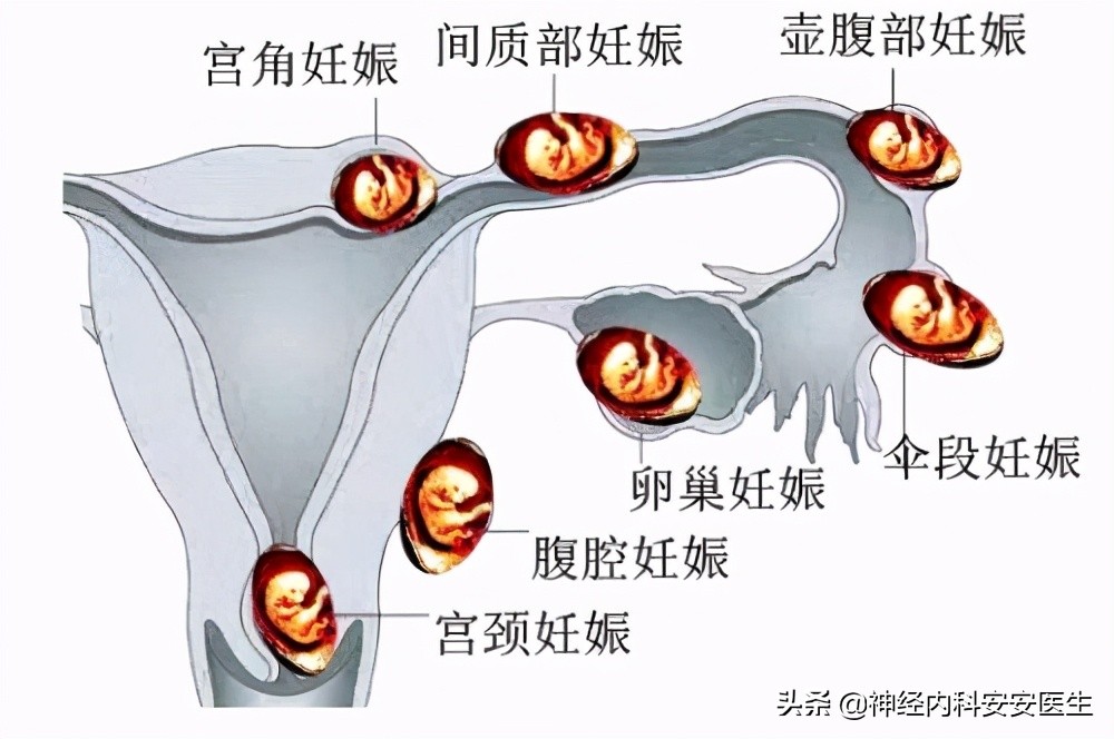 月经推迟14天意外怀孕了,月经刚完是否意外怀孕