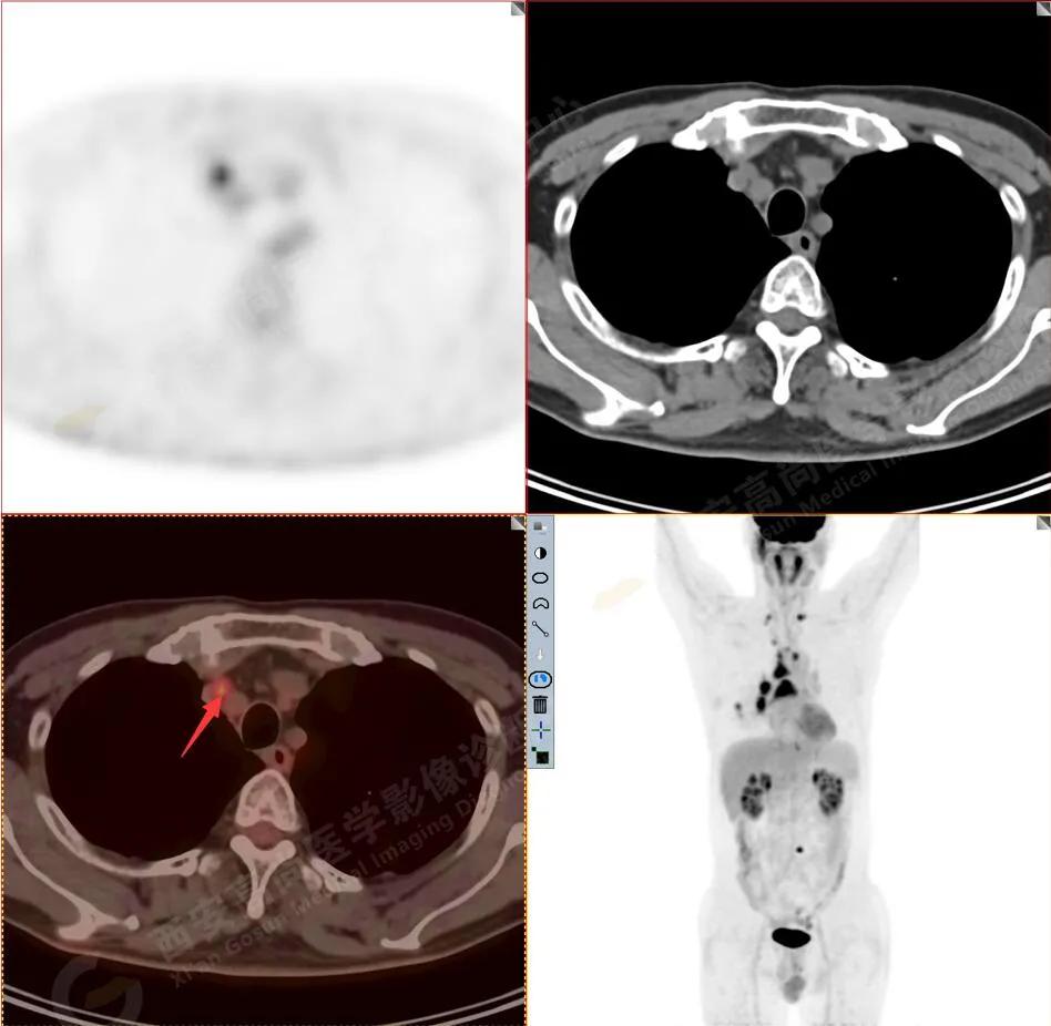 petct检查报告肺结节考虑恶性肿瘤,30mm肺结节pet显示没有转移