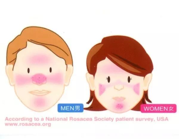 酒渣鼻有什么特效药,酒渣鼻的原因及治疗