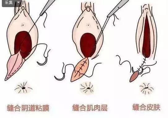 顺产挨的“那一刀”，还有多少女人心有余悸？