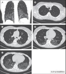 系统性硬化病患者可以怀孕吗,免疫相关不良妊娠诊断指南
