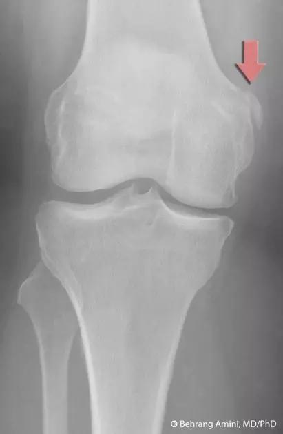 所有骨折都叫什么名字,骨折的名称有哪些