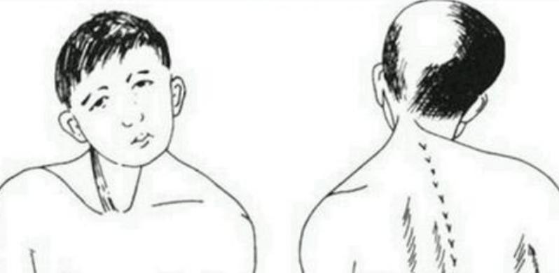 药物失效，肉毒素也失效，该拿什么拯救痉挛性斜颈？