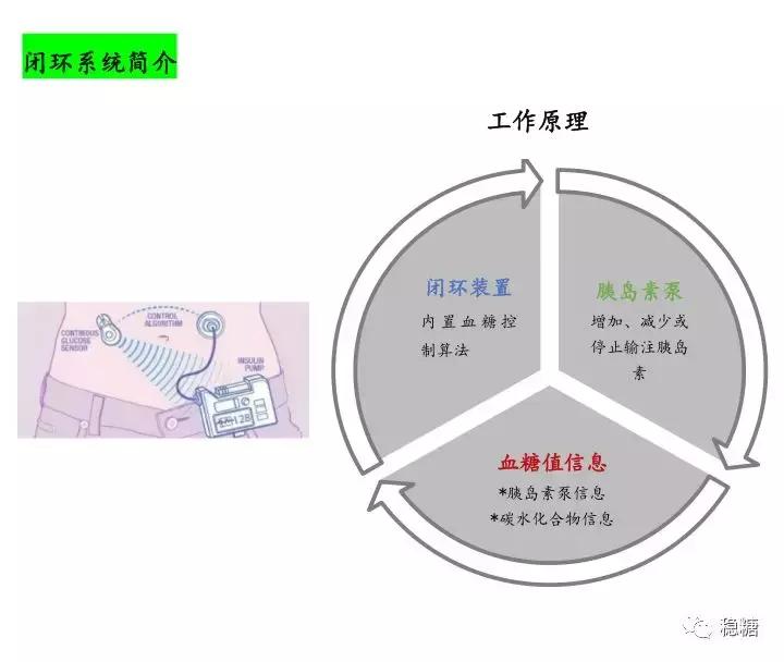 闭环式胰岛素泵会低血糖吗,闭环胰岛素泵使用寿命