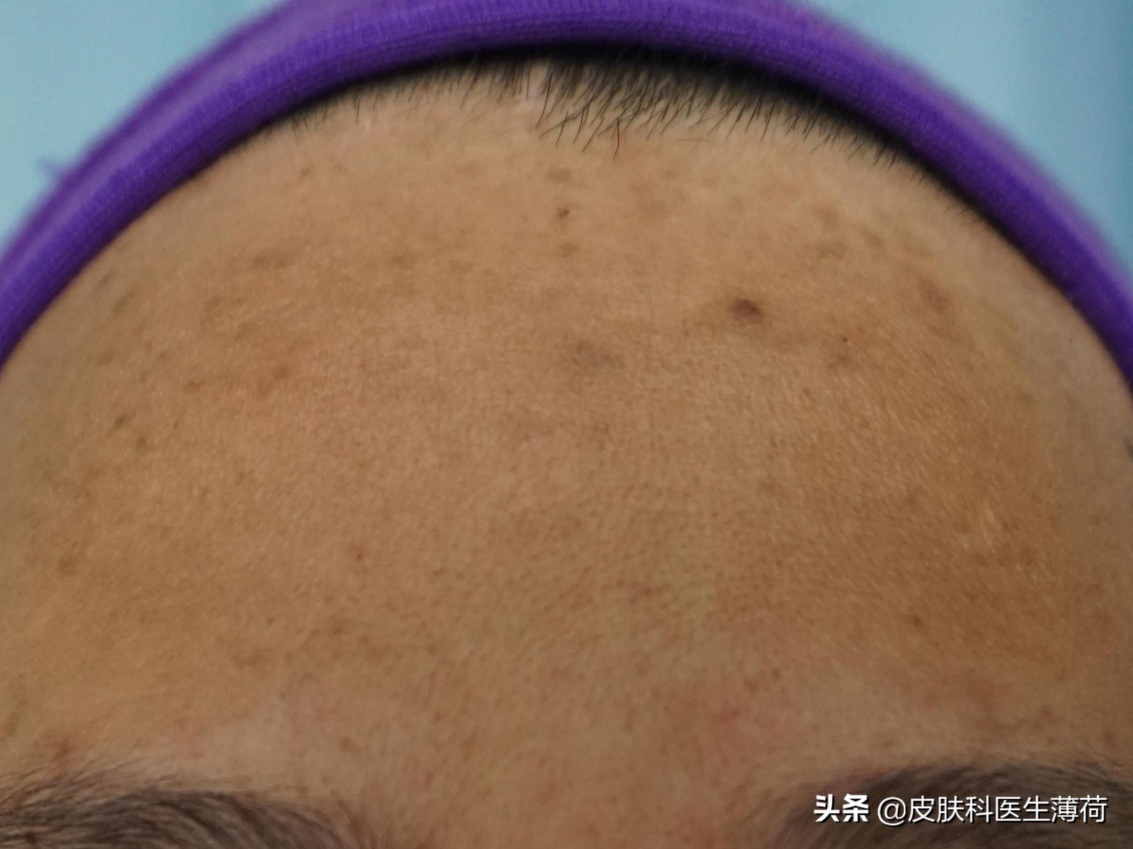 皮肤科医生教你如何处理痘印,医院的皮肤科主治痘痘痘印吗