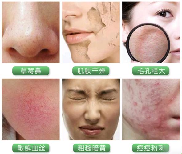 黑头疯长,口罩一摘吓死人?用它揉一揉,毛孔垃圾全吸走